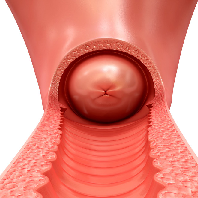 Dysplasia of the cervix