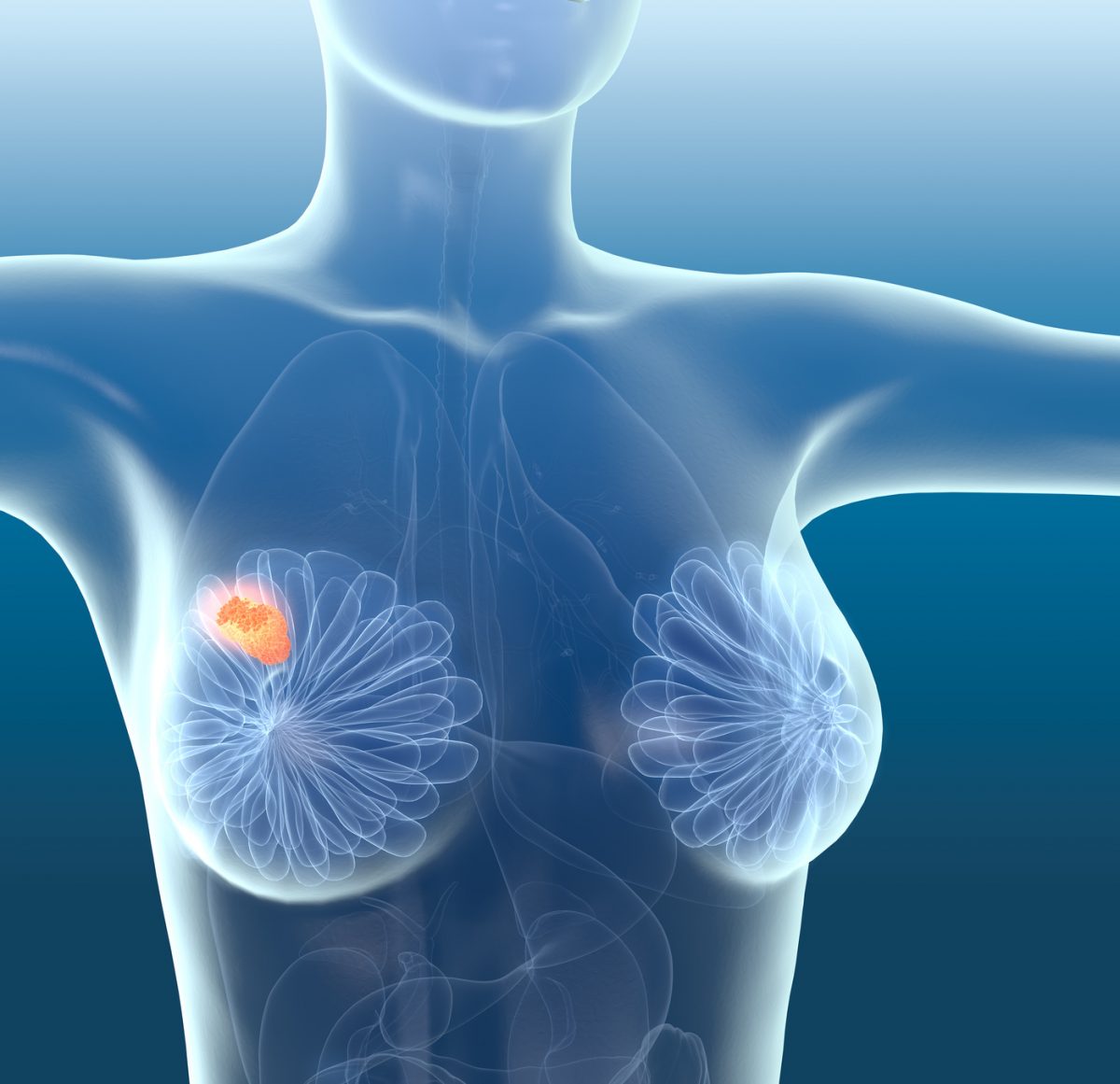 Fibroadenoma of the breast and fibrocystic mastopathy: main symptoms, diagnosis and treatment